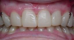 restauration-dentaire-resine1.jpg