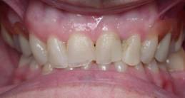 restauration-dentaire-resine2.jpg