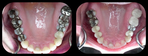 restauration-dentaire-incrustation-cerec.jpg