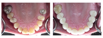 restauration-dentaire-couronne.jpg
