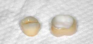 restauration-dentaire-zirconium.jpg