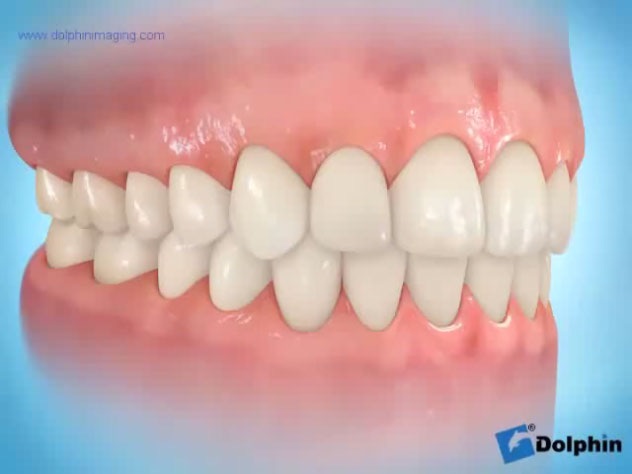 implants_dentaires-implant-unitaire.jpg