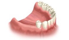 implant-multiple-implant1.jpg