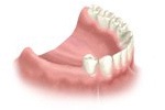 implant-multiple-implant2.jpg