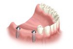 implant-multiple-implant3.jpg