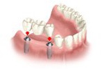 implant-multiple-implant4.jpg