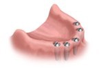 implant-total-implant3.jpg