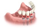 implant-total-implant4.jpg