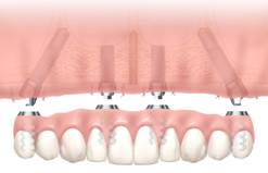 implant-allon1-image2.jpg