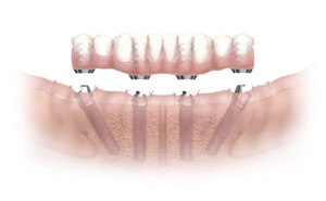 implant-allon1-image1.jpg